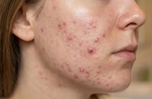 Dermal Filler
